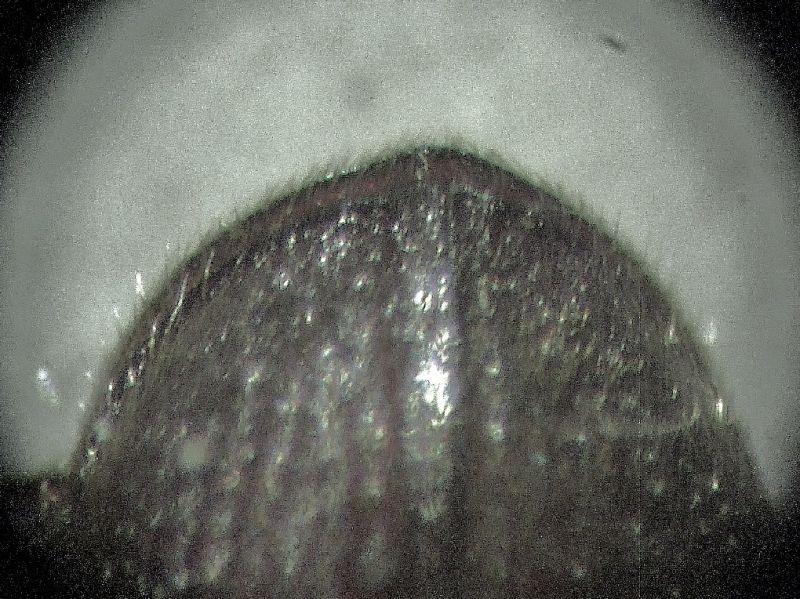 Cal particol addome 001.jpg